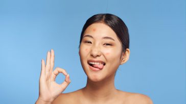 The Truth on Blind Pimples and How to Get Rid of Them