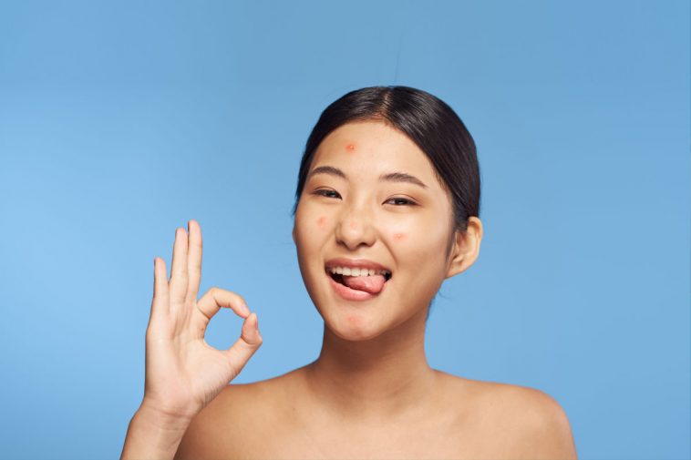 The Truth on Blind Pimples and How to Get Rid of Them